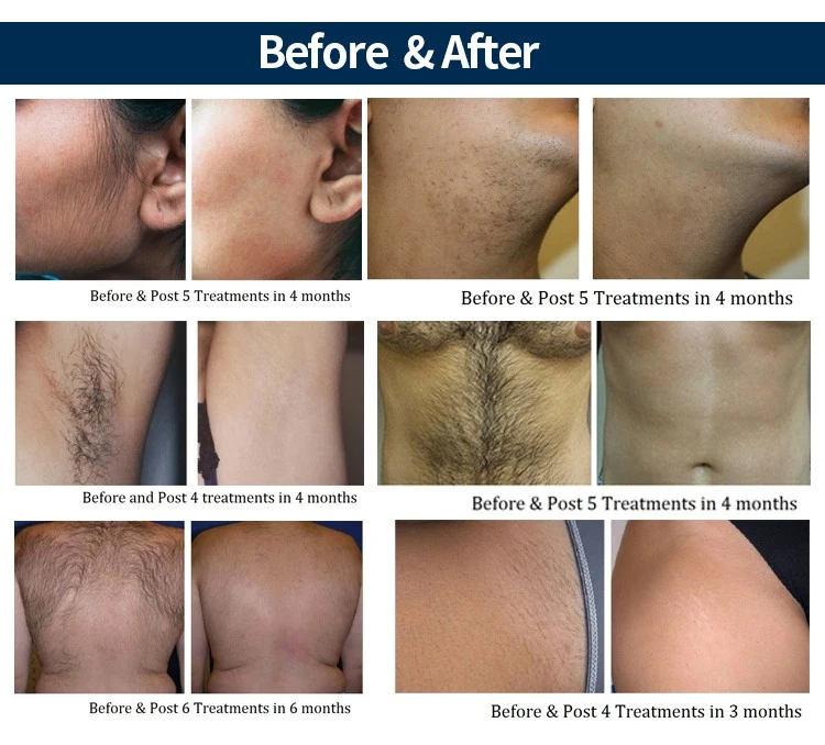 diode laser hair removal machine4
