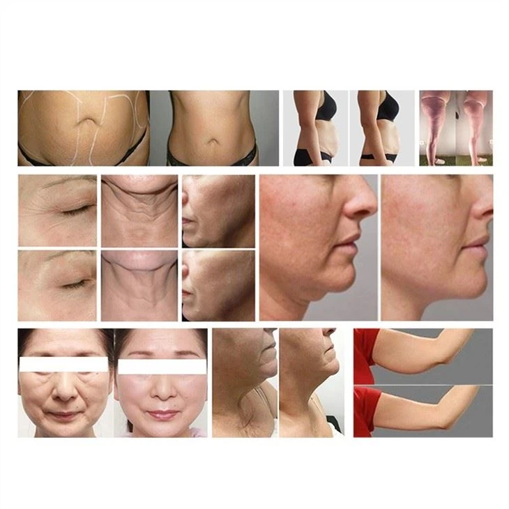 Vacuum RF Roller LED IR Body Slimming Body Shaping Machine